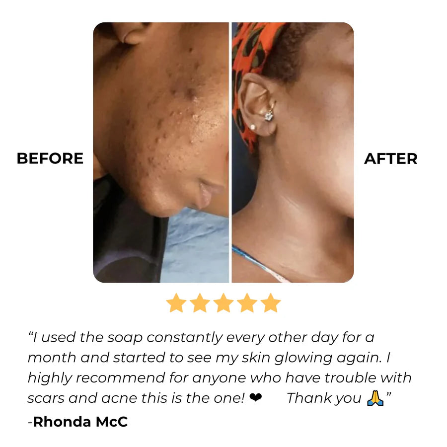 Kojic Acid & Turmeric Soap